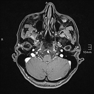 File:Basilar artery perforator aneurysm (Radiopaedia 82455-99523 G 16).jpg
