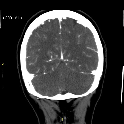 File:Basilar artery thrombosis (Radiopaedia 16260-15944 B 52).jpg