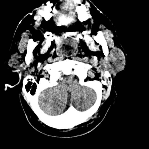 Basilar artery thrombosis (Radiopaedia 53351-59333 Axial non-contrast 21).jpg