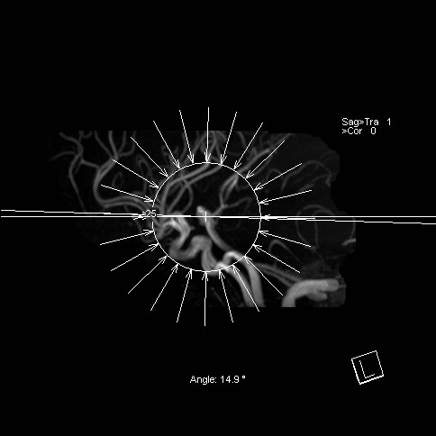 Basilar tip aneurysm (Radiopaedia 26504-26632 D 26).jpg