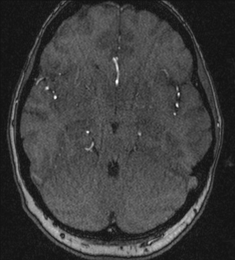 Basilar tip aneurysm (Radiopaedia 26504-26632 MRA 89).jpg