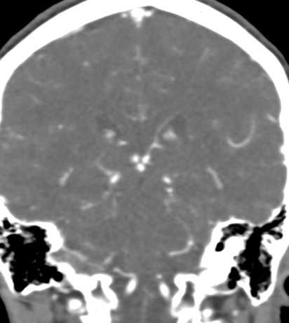 File:Basilar tip aneurysm with coiling (Radiopaedia 53912-60086 B 97).jpg