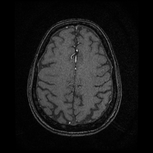 Basilar top and left middle cerebral artery aneurysm (Radiopaedia 61965-70031 Axial MRA 130).jpg