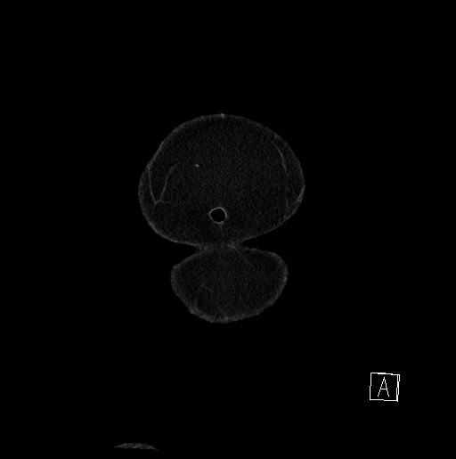 Below filter IVC thrombosis (Radiopaedia 58187-65266 B 8).jpg