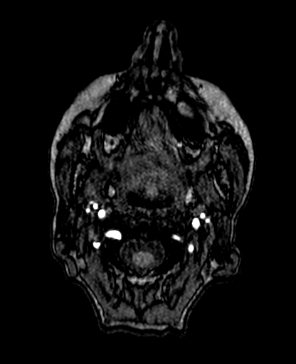 Berry aneurysm of the terminal internal carotid artery (Radiopaedia 88286-104918 Axial TOF 7).jpg