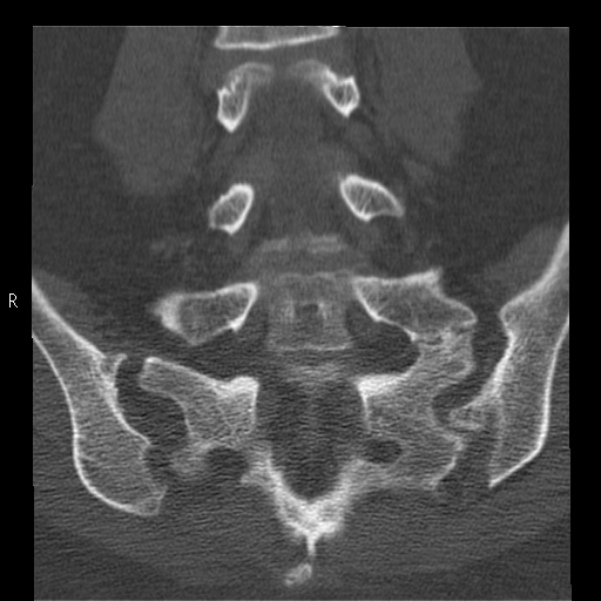 Bertolotti syndrome (Radiopaedia 24864-25128 Coronal bone window 29).jpg