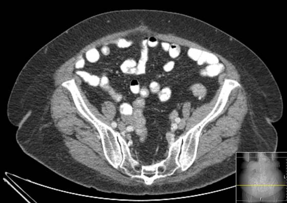 Bicameral celiacomesenteric aneurysm (Radiopaedia 55766-62327 A 53).jpg