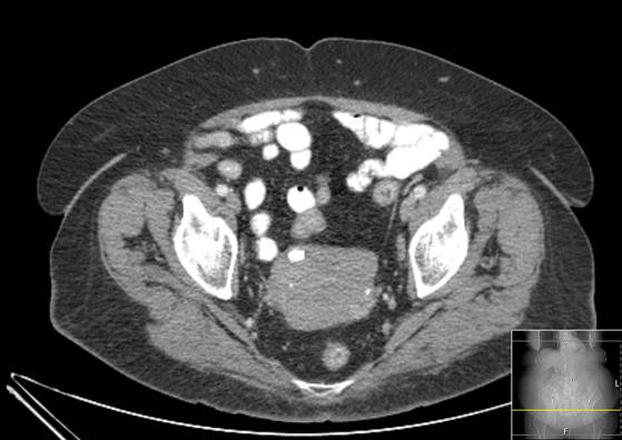 Bicameral celiacomesenteric aneurysm (Radiopaedia 55766-62327 A 62).jpg