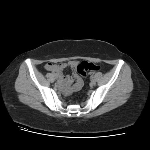 File:Bicornuate uterus- on MRI (Radiopaedia 49206-54296 Axial non-contrast 5).jpg