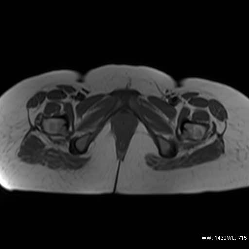 File:Bicornuate uterus (MRI) (Radiopaedia 49206-54297 Axial 10).jpg