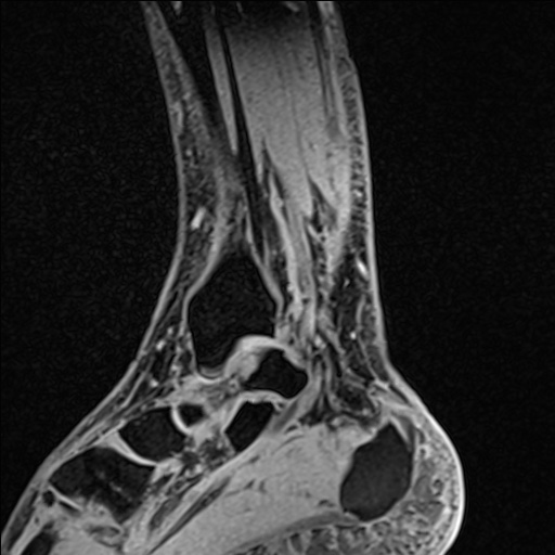 Bilateral Achilles tendon complete tear (Radiopaedia 81344-95051 Sagittal WE - Left 42).jpg