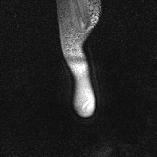 File:Bilateral Achilles tendon complete tear (Radiopaedia 81344-95051 Sagittal WE - Right 6).jpg