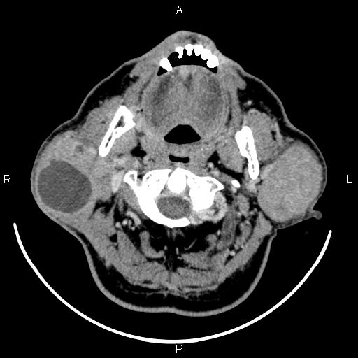 File:Bilateral Warthin tumors (Radiopaedia 84034-99263 Axial With contrast 21).jpg