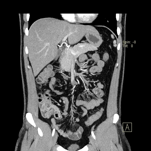 File:Bilateral accessory renal arteries with mild pelvi-ureteric junction (PUJ) obstruction (Radiopaedia 66357-75596 B 4).jpg