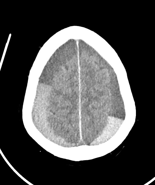 Bilateral acute on chronic subdural hematomas (Radiopaedia 78466-91146 Axial non-contrast 44).jpg