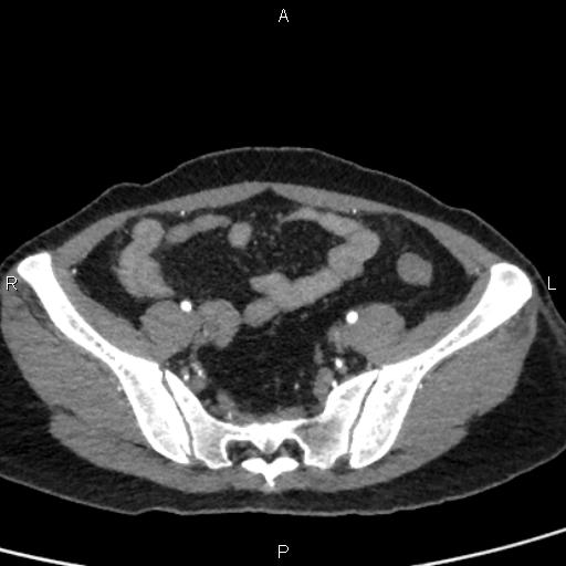 Bilateral adrenal gland hyperenhancement in pancreatitis (Radiopaedia 86642-102753 B 103).jpg