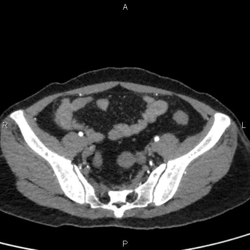 File:Bilateral adrenal gland hyperenhancement in pancreatitis (Radiopaedia 86642-102753 B 104).jpg