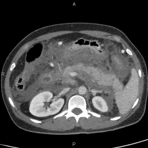 Bilateral adrenal gland hyperenhancement in pancreatitis (Radiopaedia 86642-102753 E 36).jpg