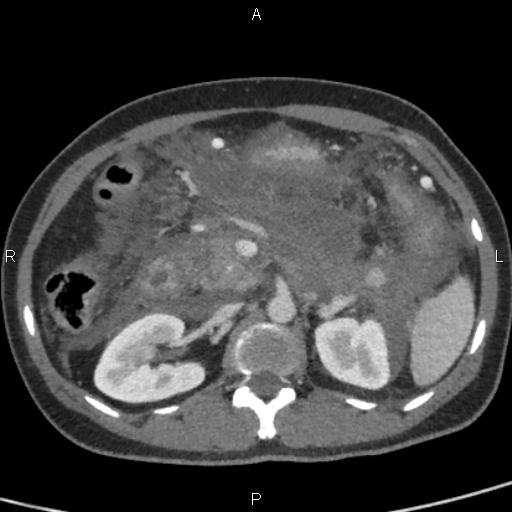 File:Bilateral adrenal gland hyperenhancement in pancreatitis (Radiopaedia 86642-102753 E 40).jpg