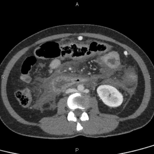 File:Bilateral adrenal gland hyperenhancement in pancreatitis (Radiopaedia 86642-102753 E 60).jpg
