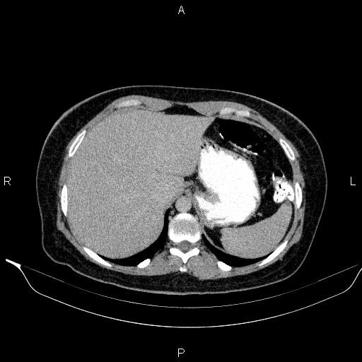 Bilateral adrenal myelolipoma (Radiopaedia 63058-71535 Axial C+ delayed 7).jpg