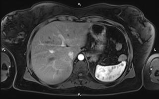 File:Bilateral adrenal myelolipoma (Radiopaedia 63058-71537 Axial T1 C+ fat sat 24).jpg
