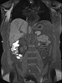 File:Bilateral adrenal myelolipoma (Radiopaedia 63058-71537 Coronal T1 fat sat 54).jpg