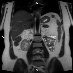 File:Bilateral adrenal myelolipoma (Radiopaedia 63058-71537 Coronal T2 13).jpg