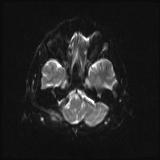 Bilateral basal ganglia and thalamic T1 hyperintensities (Radiopaedia 19764-19802 Axial DWI 4).jpg