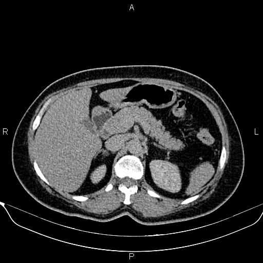 File:Bilateral benign adrenal adenomas (Radiopaedia 86912-103124 Axial C+ delayed 37).jpg