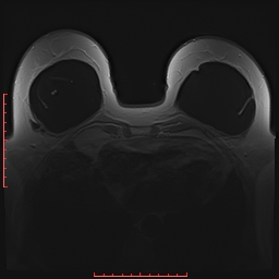 File:Bilateral breast implant rupture (Radiopaedia 24761-25027 PASTA 18).jpg