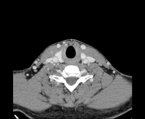 File:Bilateral carotid body tumors (Radiopaedia 61841-69870 Axial Post contrast 83).jpg