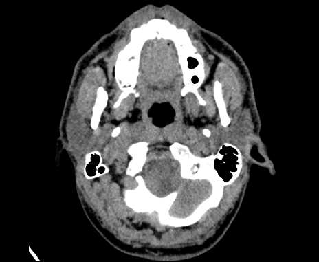 Bilateral carotid body tumors (Radiopaedia 61841-69870 Axial non-contrast 16).jpg