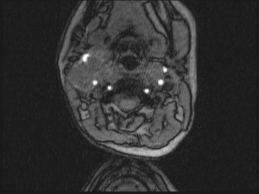 Bilateral carotid body tumors and right glomus jugulare tumor (Radiopaedia 20024-20060 Axial MRA 261).jpg