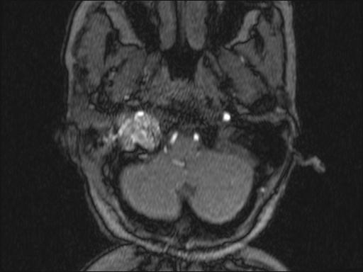 Bilateral carotid body tumors and right glomus jugulare tumor (Radiopaedia 20024-20060 Axial MRA 304).jpg