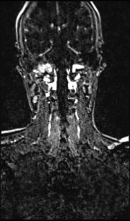 File:Bilateral carotid body tumors and right glomus jugulare tumor (Radiopaedia 20024-20060 MRA 122).jpg