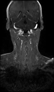 Bilateral carotid body tumors and right glomus jugulare tumor (Radiopaedia 20024-20060 MRA 57).jpg