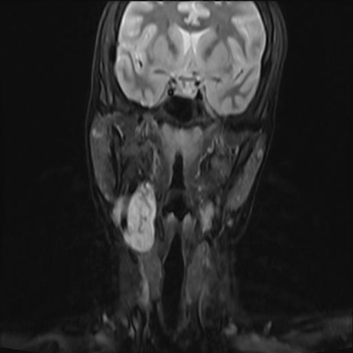File:Bilateral carotid body tumors and right jugular paraganglioma (Radiopaedia 20024-20060 Coronal 30).jpg