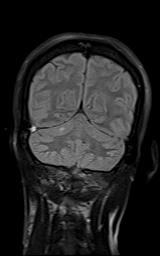 File:Bilateral carotid body tumors and right jugular paraganglioma (Radiopaedia 20024-20060 Coronal 62).jpg