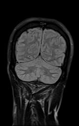 File:Bilateral carotid body tumors and right jugular paraganglioma (Radiopaedia 20024-20060 Coronal 64).jpg