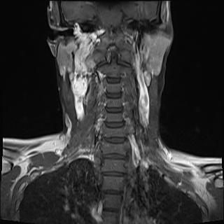 File:Bilateral carotid body tumors and right jugular paraganglioma (Radiopaedia 20024-20060 None 8).jpg