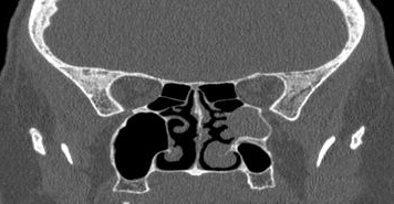File:Bilateral ectopic infraorbital nerves (Radiopaedia 49006-54084 Coronal 16).png