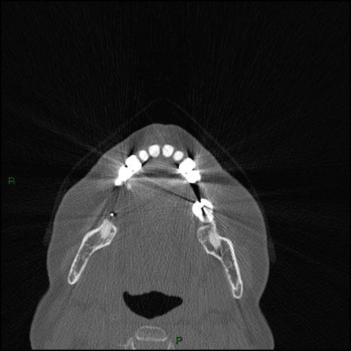 Bilateral frontal mucoceles (Radiopaedia 82352-96454 Axial bone window 281).jpg