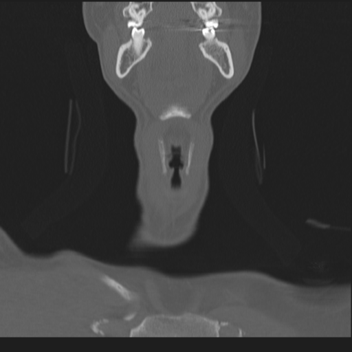 File:Bilateral locked facets (Radiopaedia 33850-35016 Coronal bone window 11).png