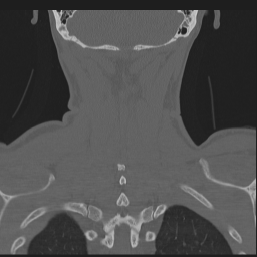 File:Bilateral locked facets (Radiopaedia 33850-35016 Coronal bone window 72).png