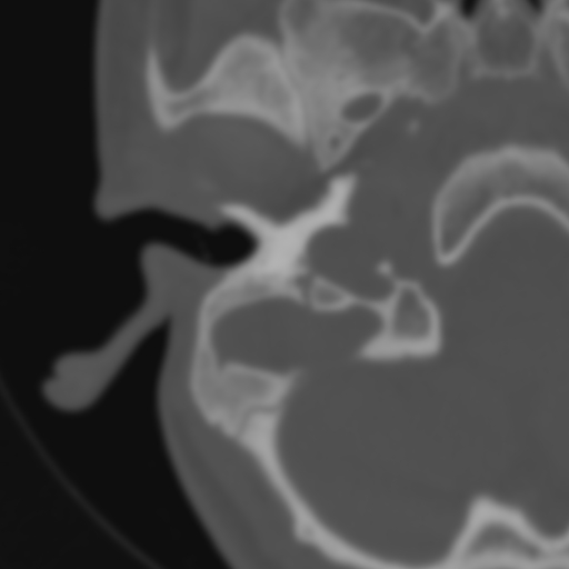 Bilateral otosclerosis (Radiopaedia 57237-64157 B 29).jpg