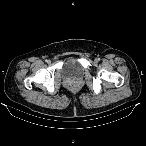 Bilateral ovarian dermoid cysts (Radiopaedia 85785-101603 A 107).jpg
