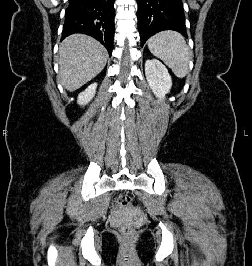 Bilateral ovarian dermoid cysts (Radiopaedia 85785-101603 C 48).jpg
