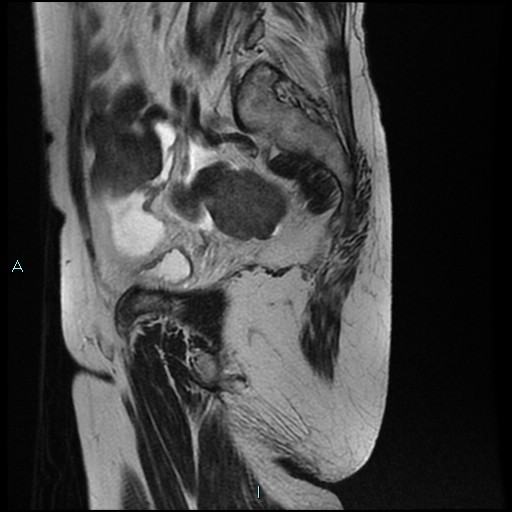 File:Bilateral ovarian fibroma (Radiopaedia 44568-48293 Sagittal T2 25).jpg