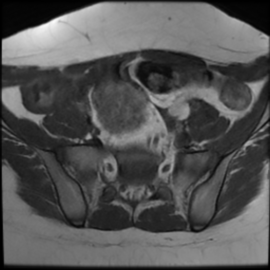 File:Bilateral ovarian fibrothecomas - adolescent (Radiopaedia 86604-102707 Axial T1 8).jpg